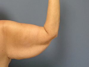 Arm Lift Before and After Pictures Nashville, TN