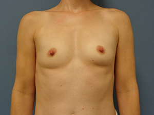Breast Augmentation Before and After Pictures Nashville, TN