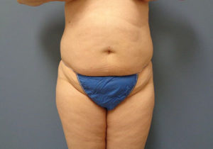 Tummy Tuck Before and After Pictures Nashville, TN