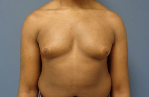 Gynecomastia Before and After Pictures Nashville, TN