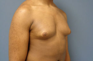 Gynecomastia Before and After Pictures Nashville, TN