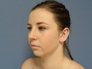 Otoplasty Before and After Pictures Nashville, TN