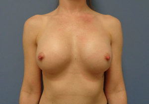 Breast Augmentation Before and After Pictures Nashville, TN