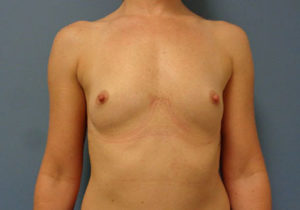 Breast Augmentation Before and After Pictures Nashville, TN