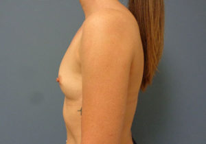 Breast Augmentation Before and After Pictures Nashville, TN