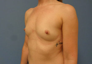Breast Augmentation Before and After Pictures Nashville, TN