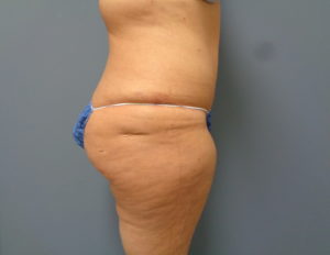 Tummy Tuck Before and After Pictures Nashville, TN