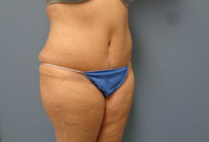 Tummy Tuck Before and After Pictures Nashville, TN