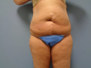 Tummy Tuck Before and After Pictures Nashville, TN