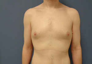 Gynecomastia Before and After Pictures Nashville, TN