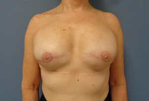 Breast Reconstruction Before and After Pictures Nashville, TN