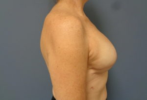 Breast Reconstruction Before and After Pictures Nashville, TN