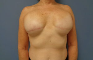 Breast Reconstruction Before and After Pictures Nashville, TN