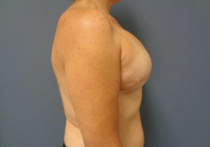 Breast Reconstruction Before and After Pictures Nashville, TN
