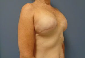 Breast Reconstruction Before and After Pictures Nashville, TN