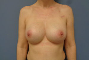 Breast Reconstruction Before and After Pictures Nashville, TN