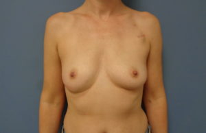 Breast Reconstruction Before and After Pictures Nashville, TN