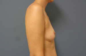 Breast Reconstruction Before and After Pictures Nashville, TN