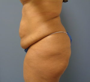 Tummy Tuck Before and After Pictures Nashville, TN