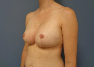Breast Augmentation with Lift Before and After Pictures Nashville, TN