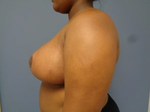 Breast Reduction Before and After Pictures Nashville, TN