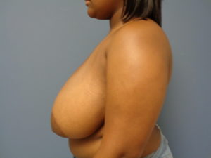 Breast Reduction Before and After Pictures Nashville, TN