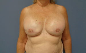 Implant Based Reconstruction Before and After Pictures Nashville, TN