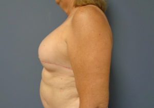 Implant Based Reconstruction Before and After Pictures Nashville, TN