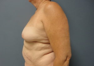 Implant Based Reconstruction Before and After Pictures Nashville, TN