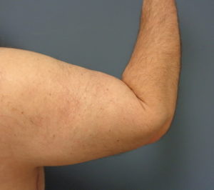 Arm Lift Before and After Pictures Nashville, TN