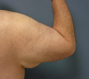 Arm Lift Before and After Pictures Nashville, TN