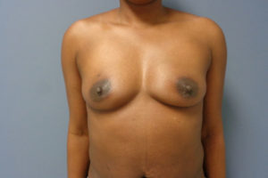 Breast Augmentation Before and After Pictures Nashville, TN