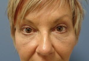 Blepharoplasty Before and After Pictures Nashville, TN