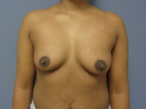 Mommy Makeover Before and After Pictures Nashville, TN